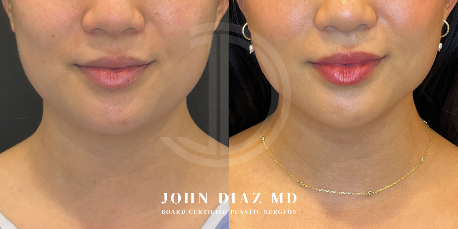 Dr John Diaz Neck Lift Before and After | Patient 7