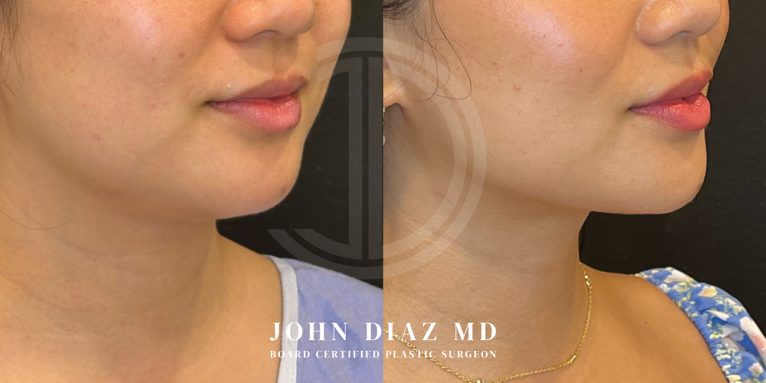 Dr John Diaz Neck Lift Before and After | Patient 7