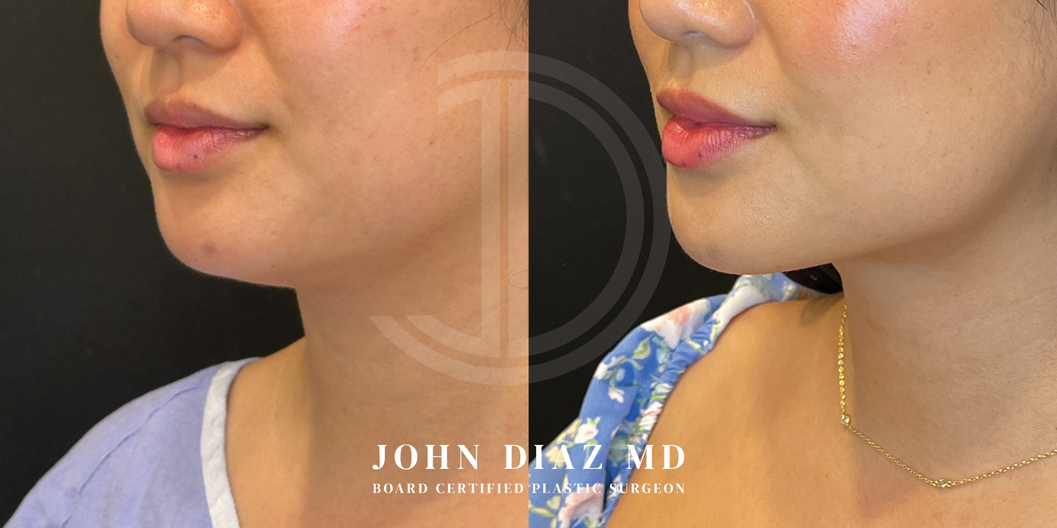 Dr John Diaz Neck Lift Before and After | Patient 7