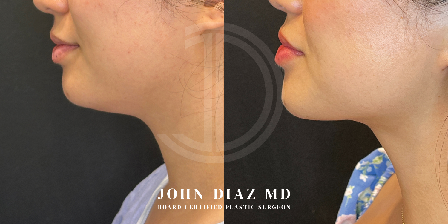 Dr John Diaz Neck Lift Before and After | Patient 7