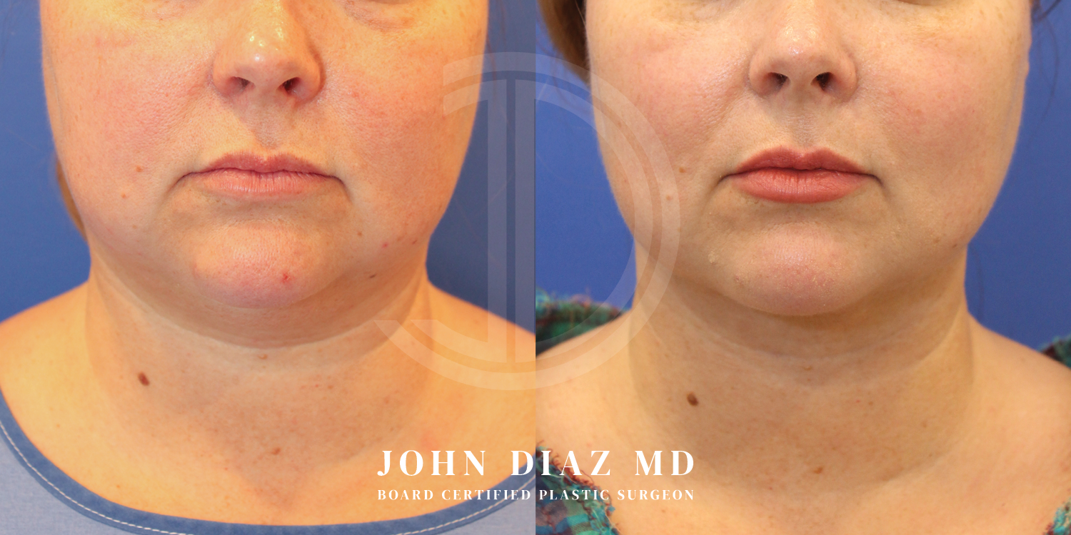 Dr John Diaz Neck Lift Before and After | Patient 8