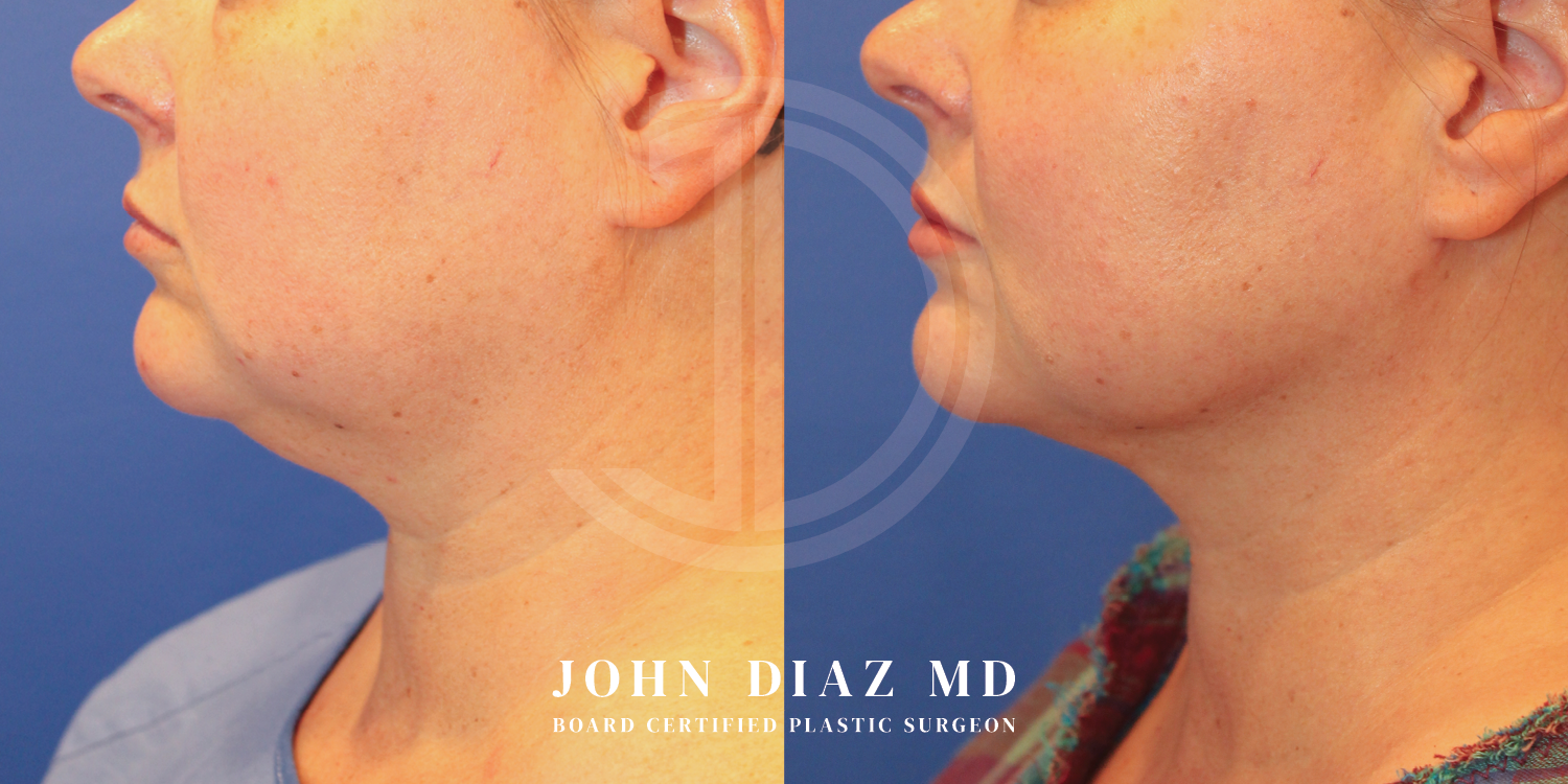Dr John Diaz Neck Lift Before and After | Patient 8