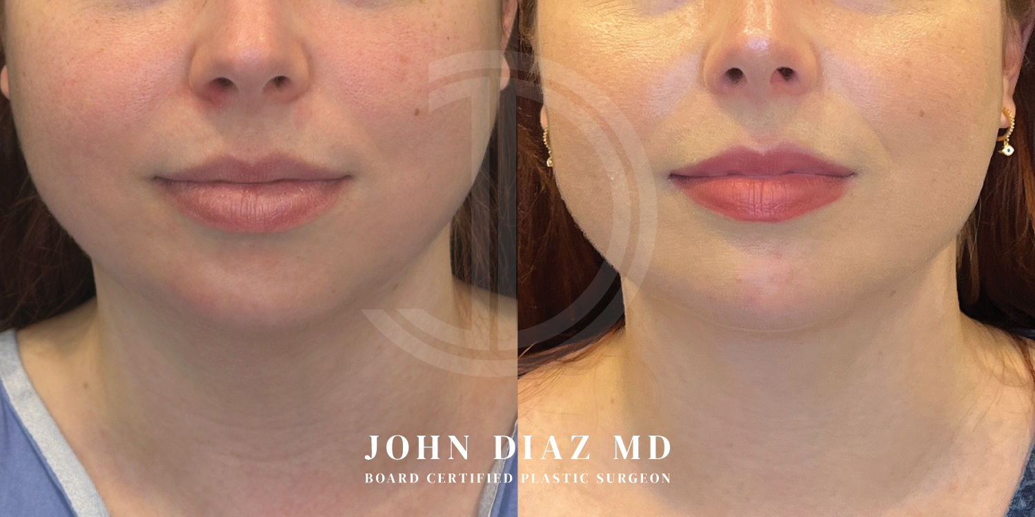 Dr John Diaz Before and After | Neck Lift, Chin Augmentation