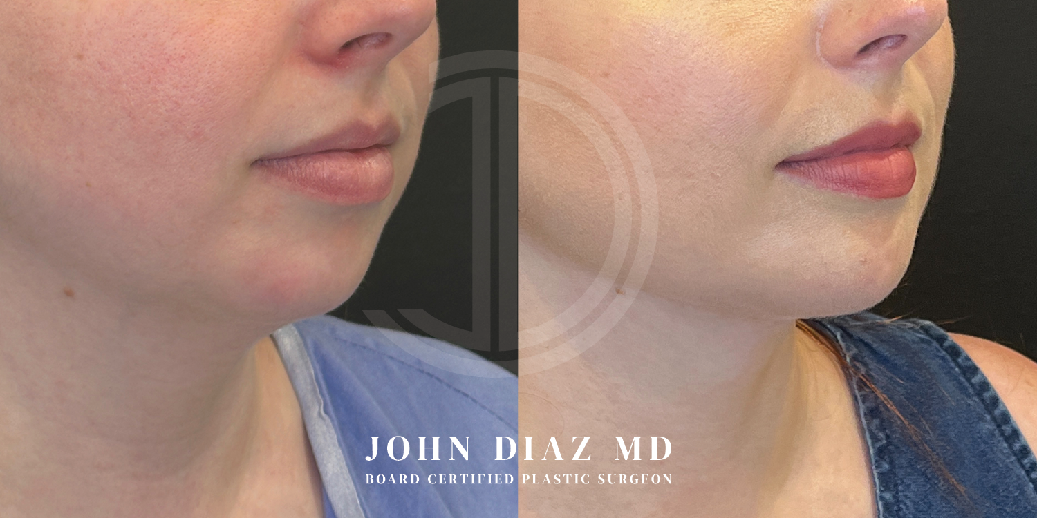 Dr John Diaz Before and After | Neck Lift, Chin Augmentation