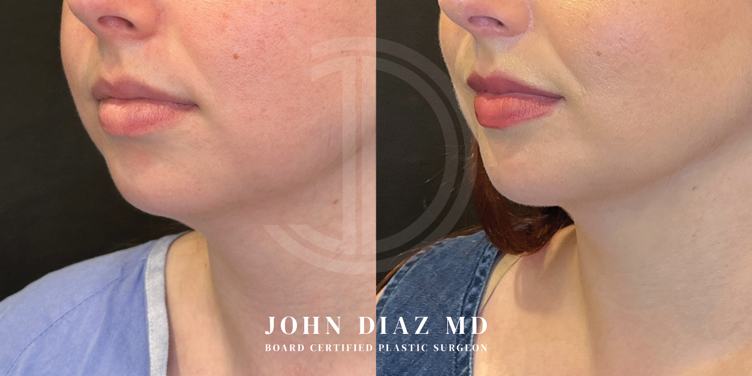 Dr John Diaz Before and After | Neck Lift, Chin Augmentation