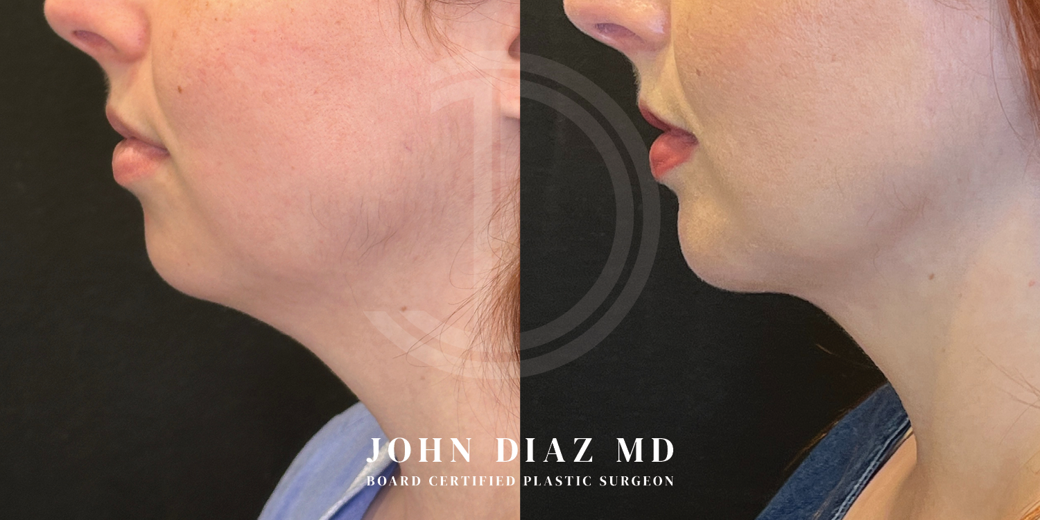 Dr John Diaz Before and After | Neck Lift, Chin Augmentation
