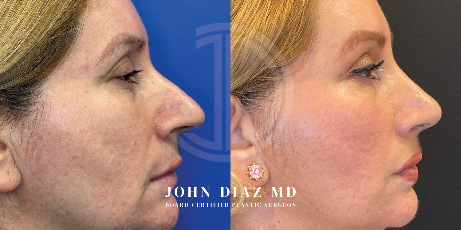 Dr John Diaz Before and After | Rhinoplasty