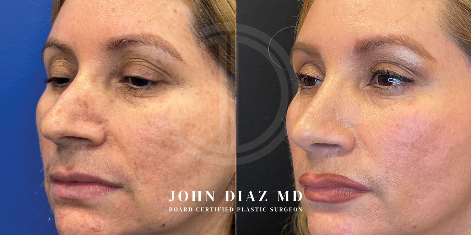 Dr John Diaz Before and After | Rhinoplasty