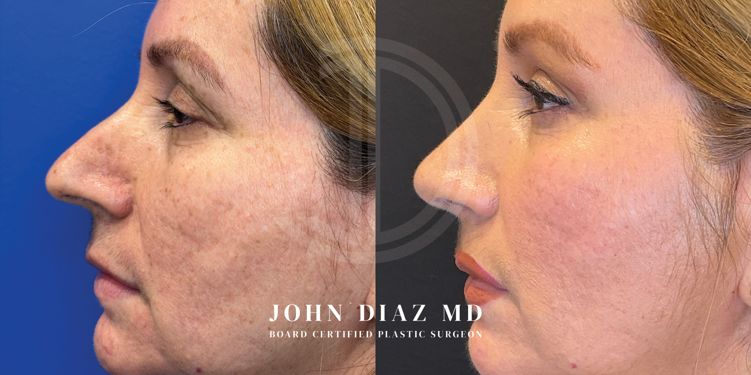 Dr John Diaz Before and After | Rhinoplasty