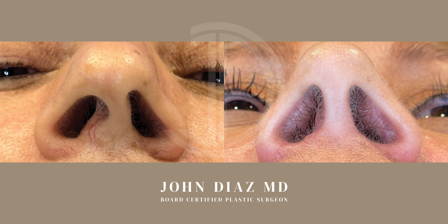 Dr John Diaz Before and After | Rhinoplasty