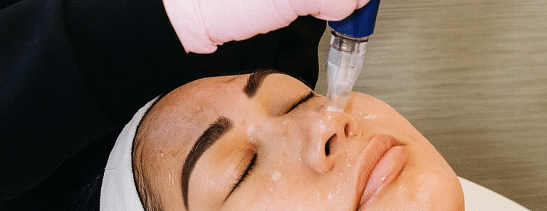 microneedling treatment beverly hills ca