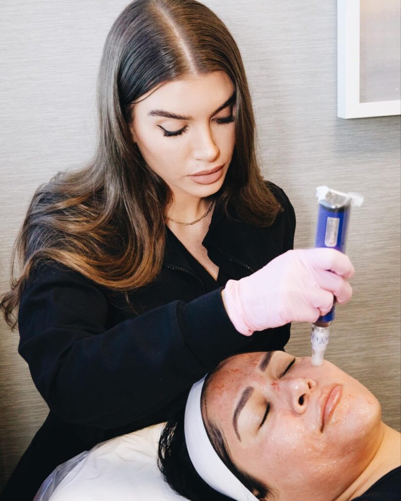 microneedling beverly hills