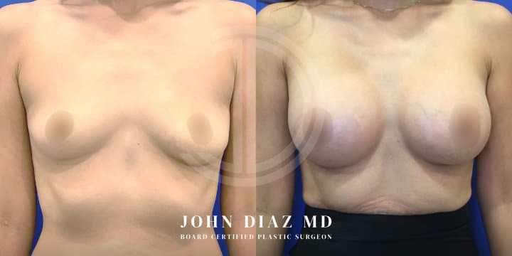 Breast Augmentation by Dr. John Diaz, Beverly Hills plastic surgeon