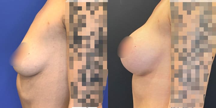 Breast Augmentation by Dr. John Diaz, Beverly Hills plastic surgeon