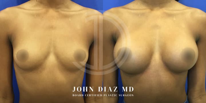 Breast Augmentation by Dr. John Diaz, Beverly Hills plastic surgeon