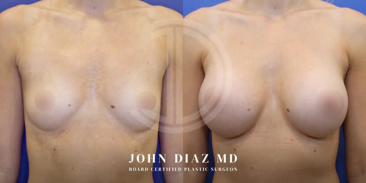 Breast Augmentation by Dr. John Diaz, Beverly Hills plastic surgeon