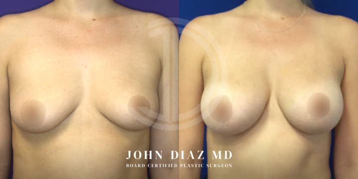 Breast Augmentation by Dr. John Diaz, Beverly Hills plastic surgeon