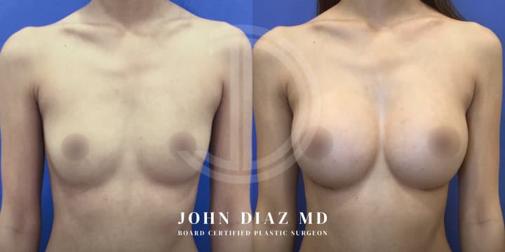 Breast Augmentation by Dr. John Diaz, Beverly Hills plastic surgeon