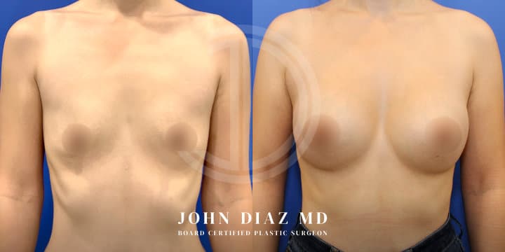 Breast Augmentation by Dr. John Diaz, Beverly Hills plastic surgeon