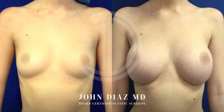 Breast Augmentation by Dr. John Diaz, Beverly Hills plastic surgeon