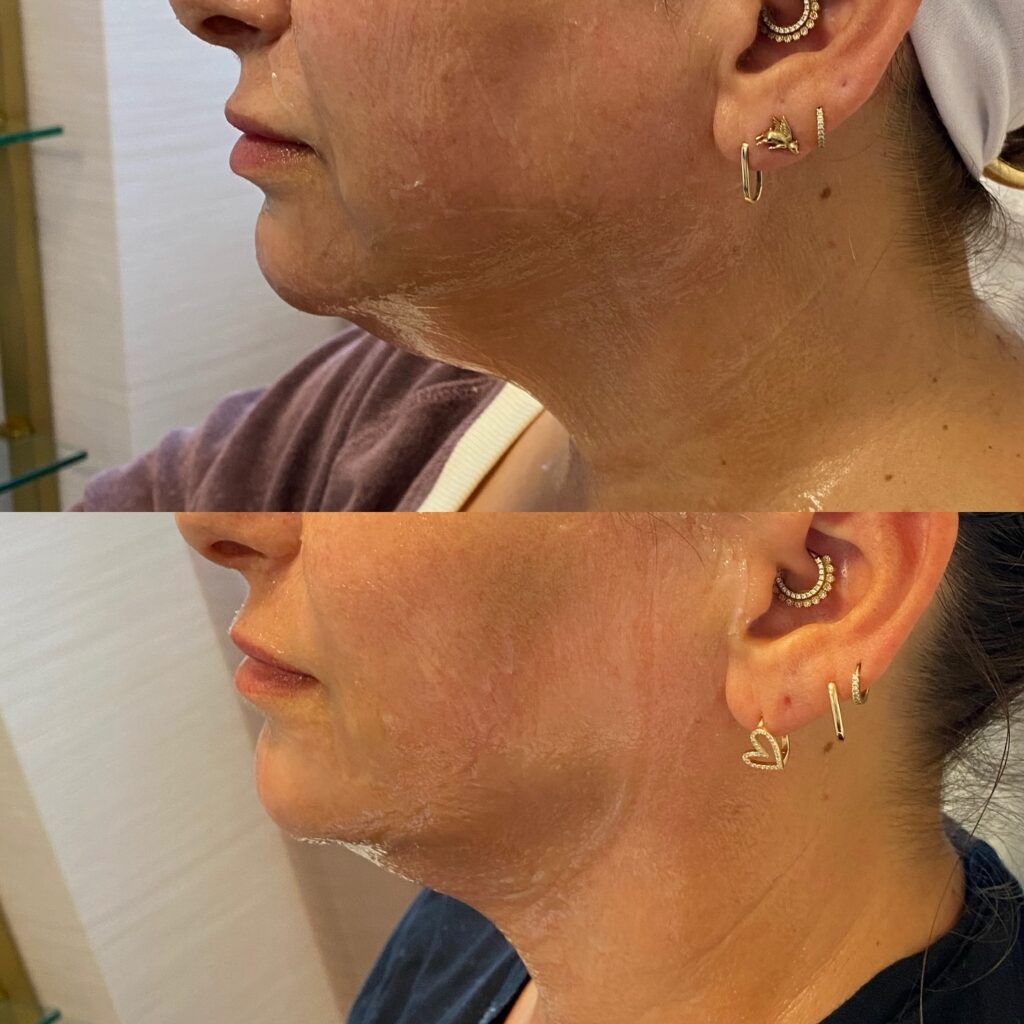 morpheus8 for jawline and jowls