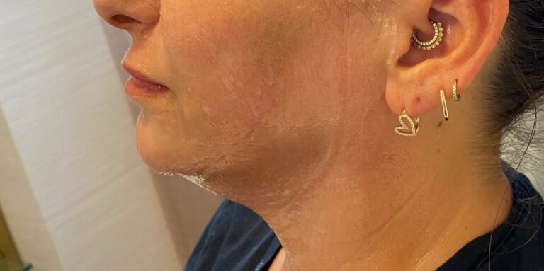 morpheus8 for jawline and jowl