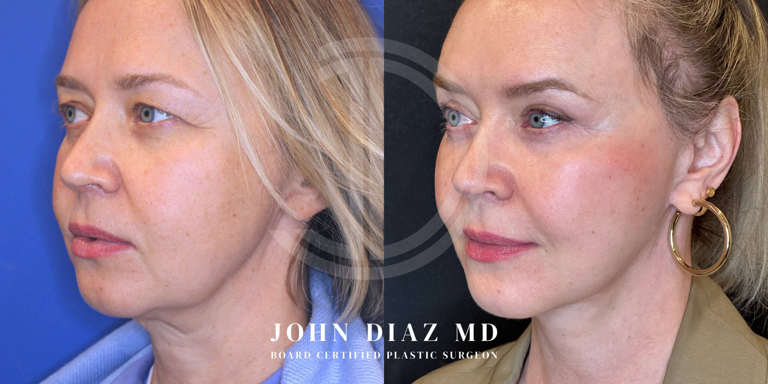 facelift before and after photos of a female patient performed by Dr. John Diaz