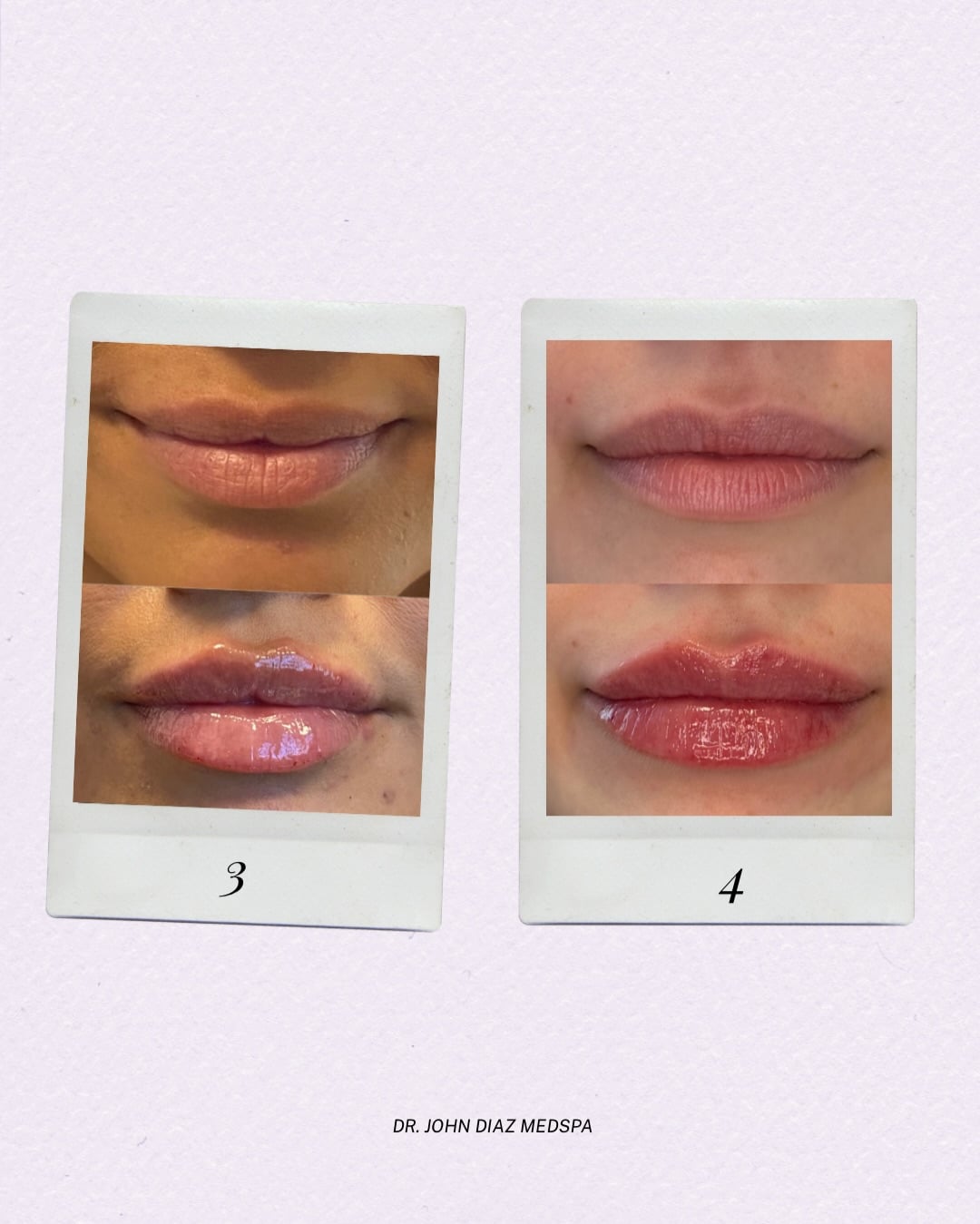  lip filler results beverly hills