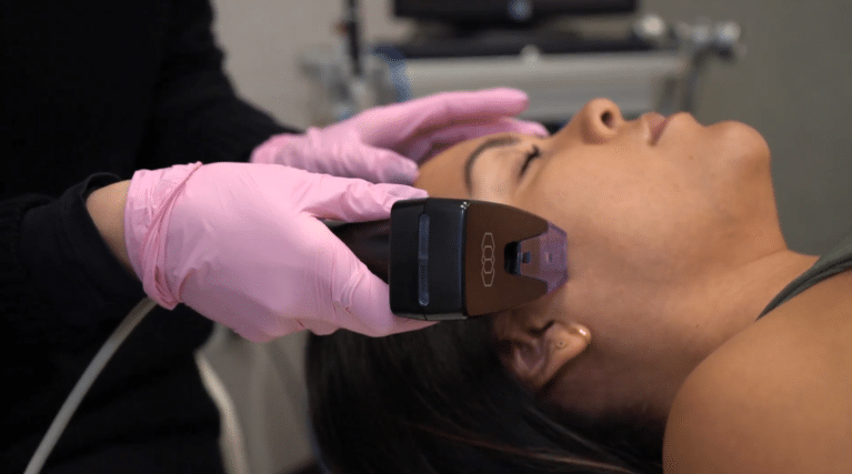 morpheus8 for acne scars and stretch marks