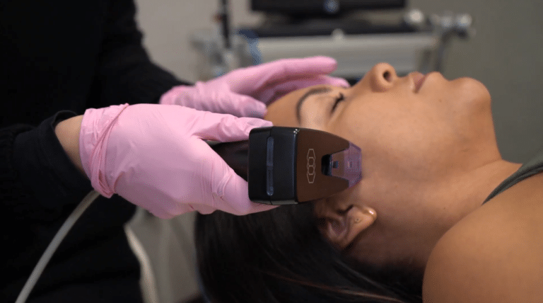 morpheus8 for acne scars and stretch marks