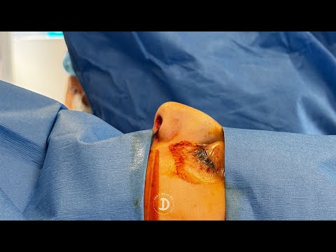 Ethnic Rhinoplasty Results video thumbnail