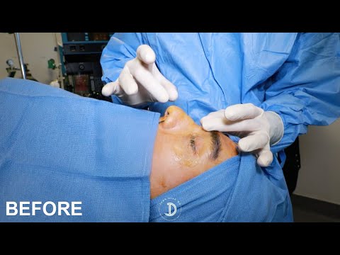 Before rhinoplasty video thumbnail