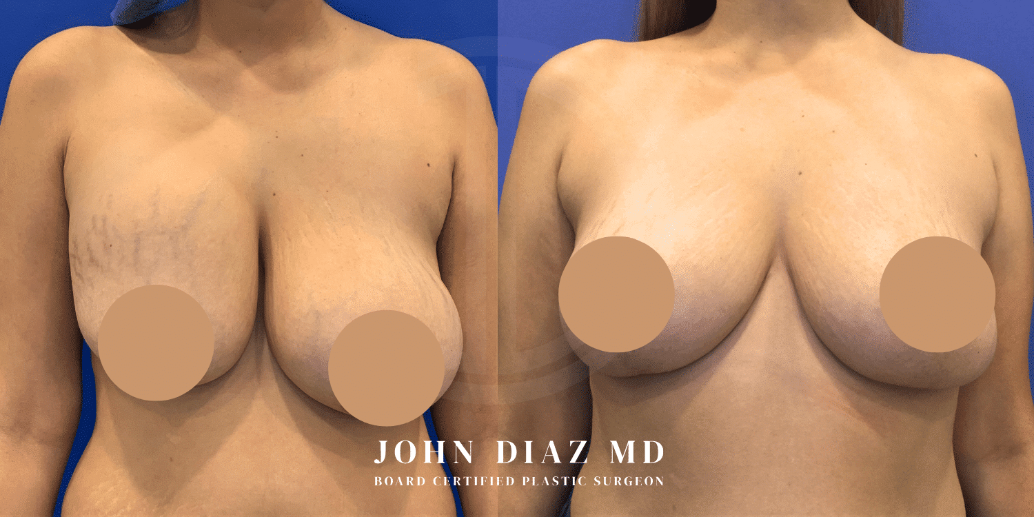 capsular contracture before and afters