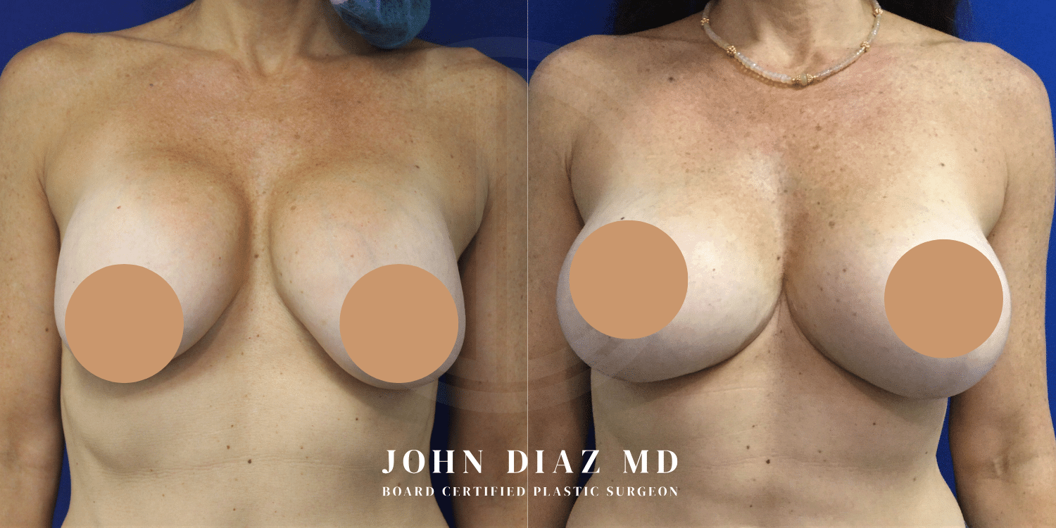 capsular contracture before and afters