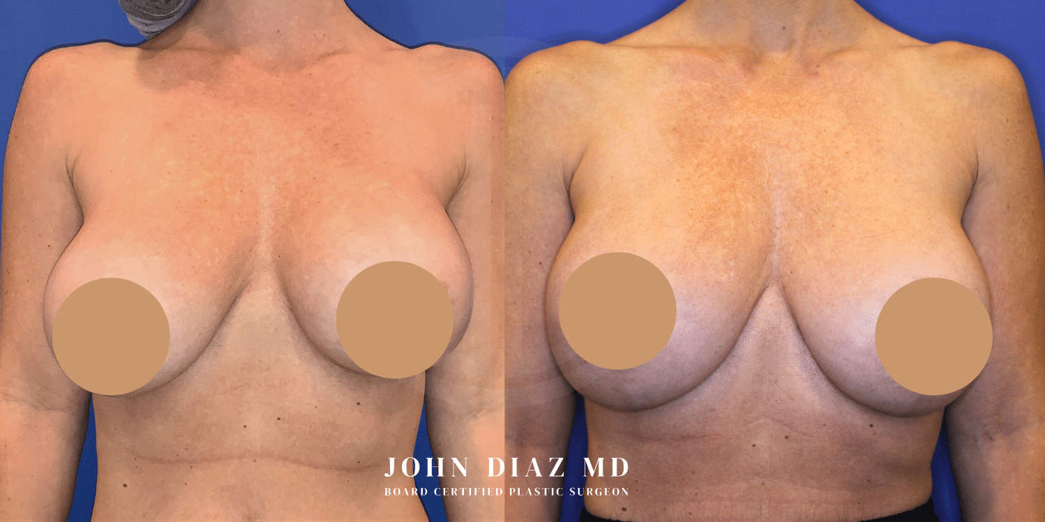 capsular contracture before and afters