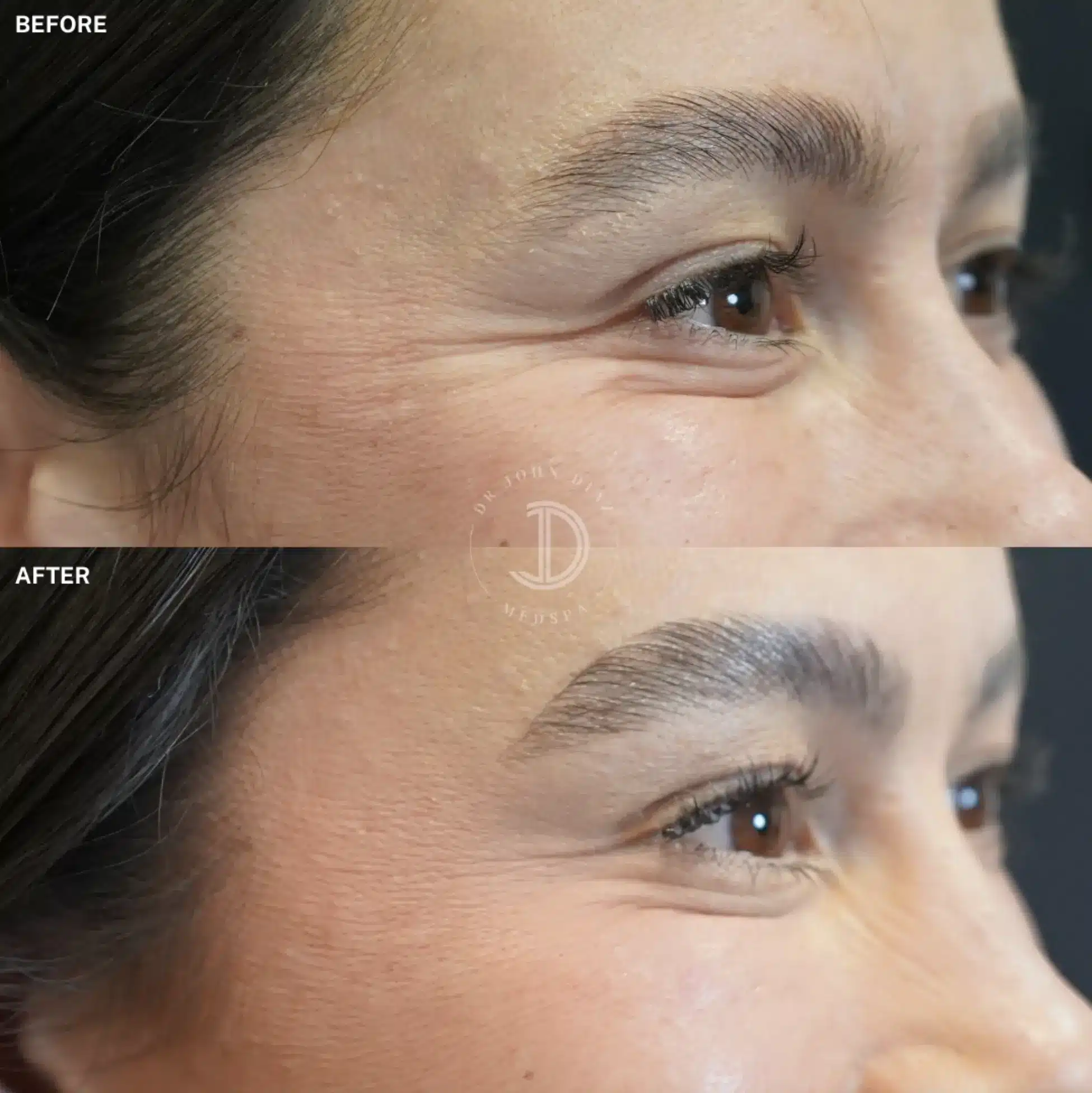 botox results in beverly hills ca