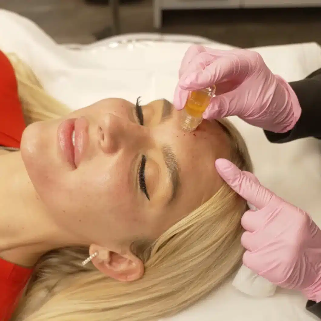 microgold facial beverly hills