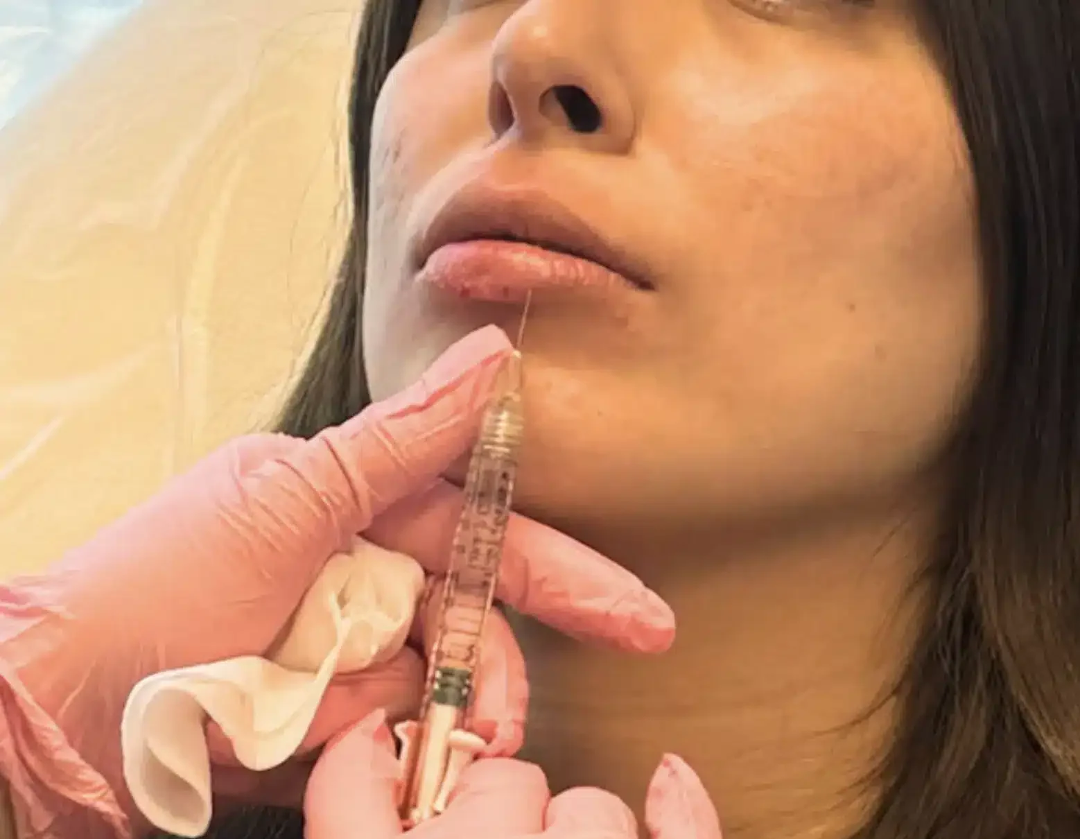 lip filler treatment beverly hills ca