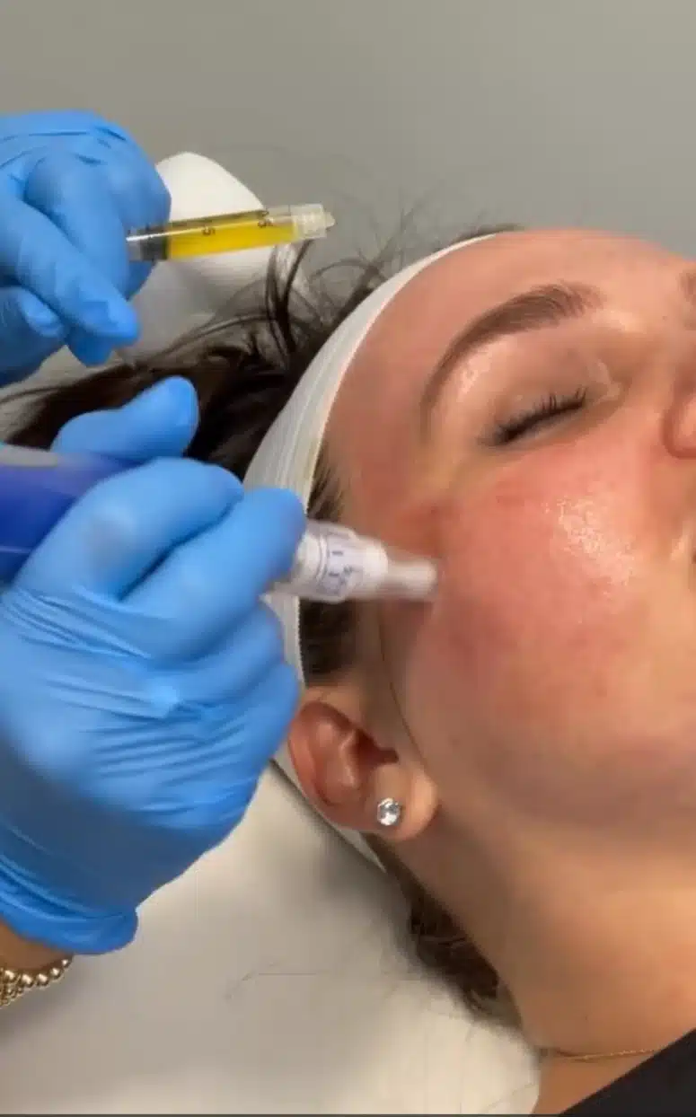 microneedling beverly hills
