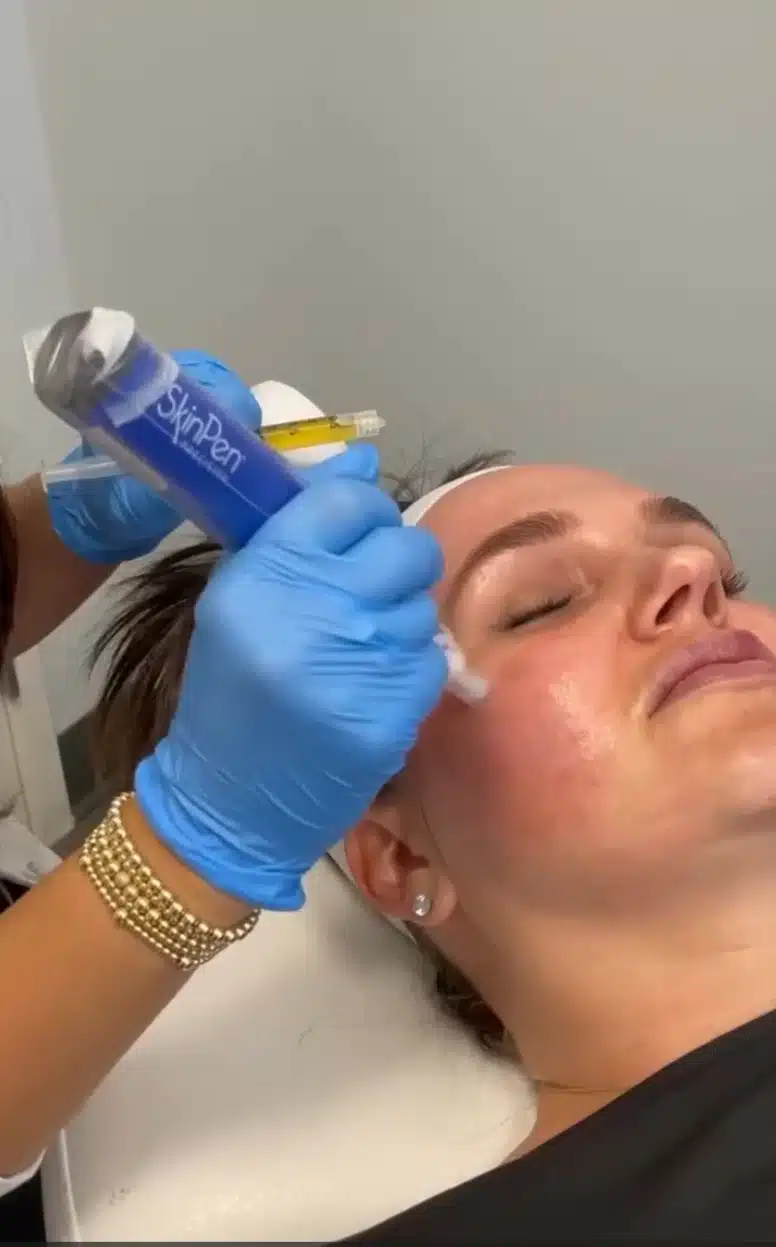 skinpen microneedling in beverly hills